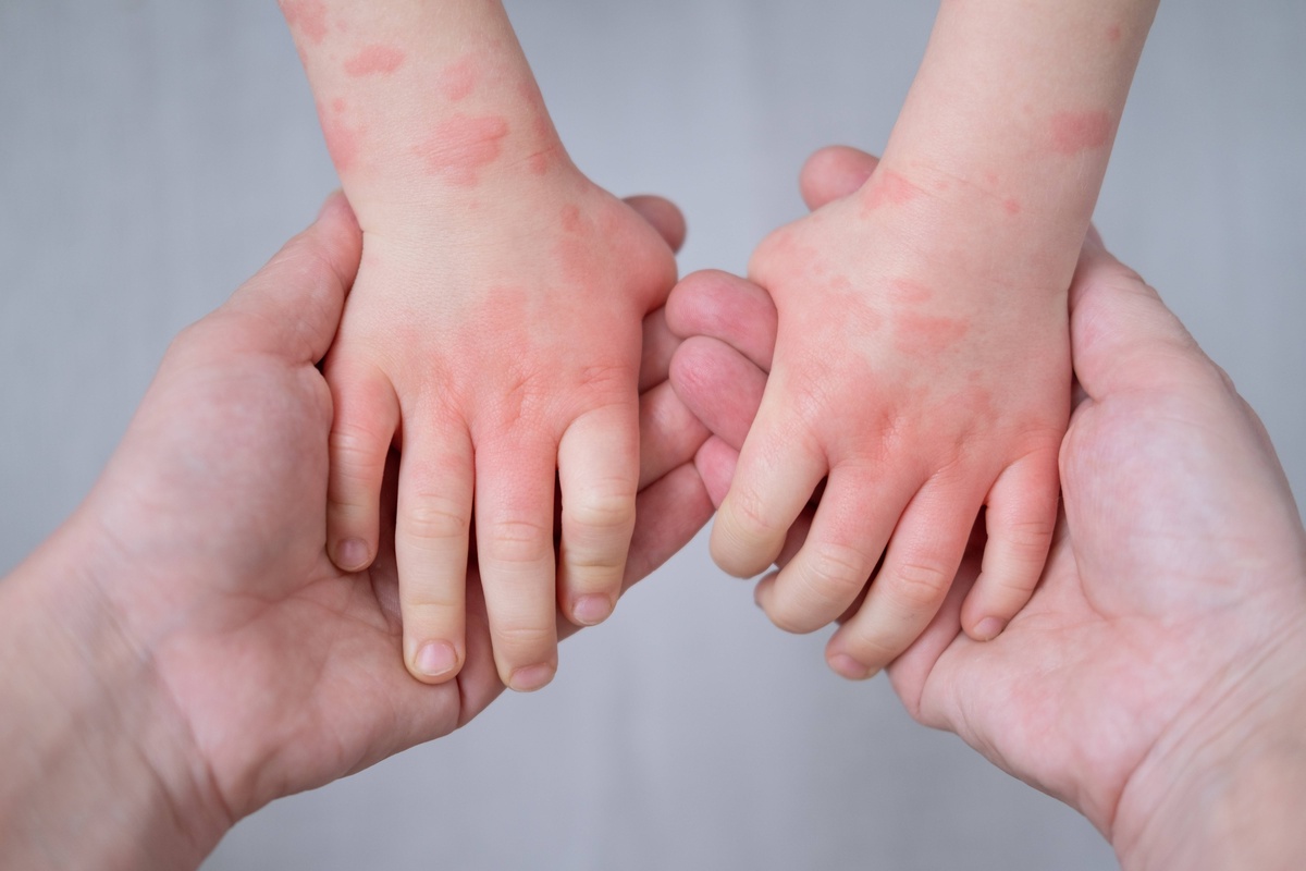 Baby Eczema: Causes, Symptoms, and Gentle Skin Care